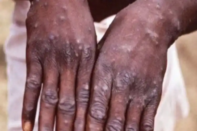 Monkeypox infected person's hands