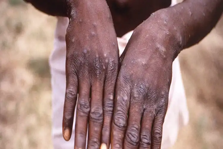 File Picture of a Monkeypox patient