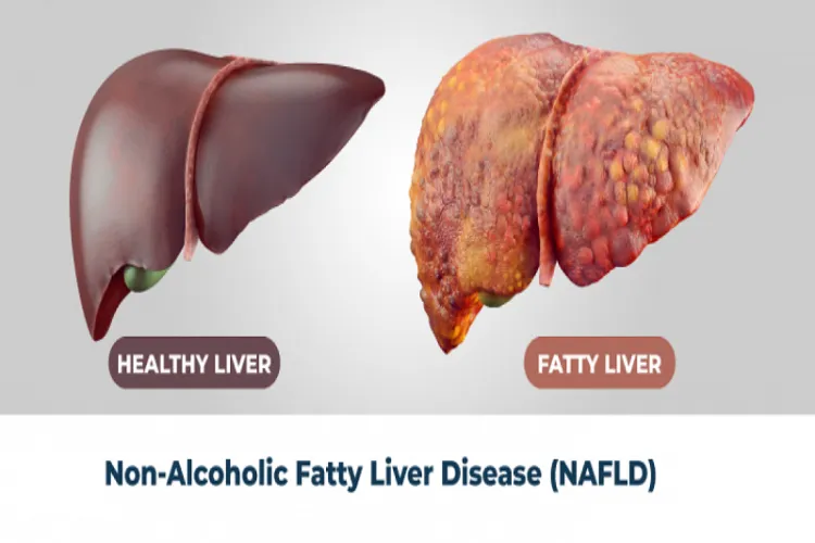 Normal liver and Fatty liver (Images for illustration)