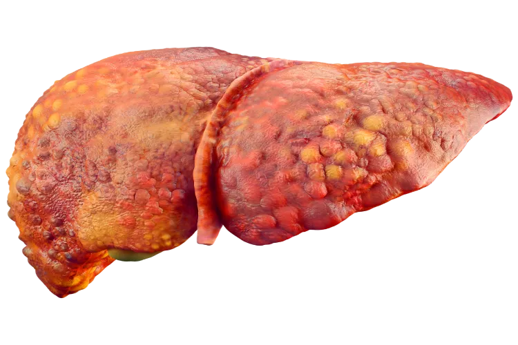 Fatty liver