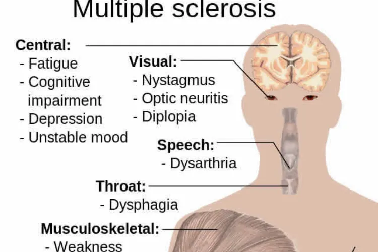 Impact of Multiple Sclerosis (Diagram)